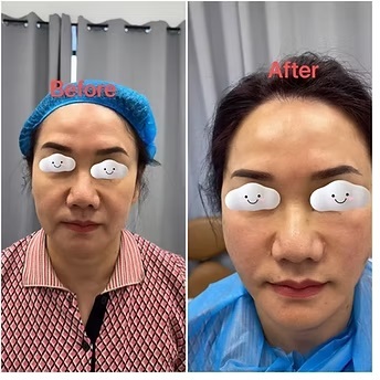 面部提升紧致前后对比