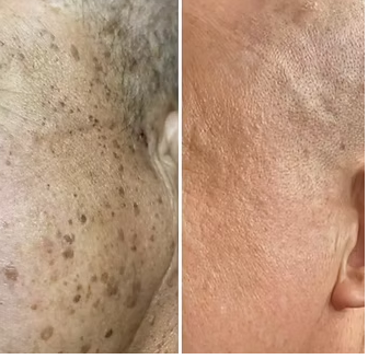 祛斑案例前后对比